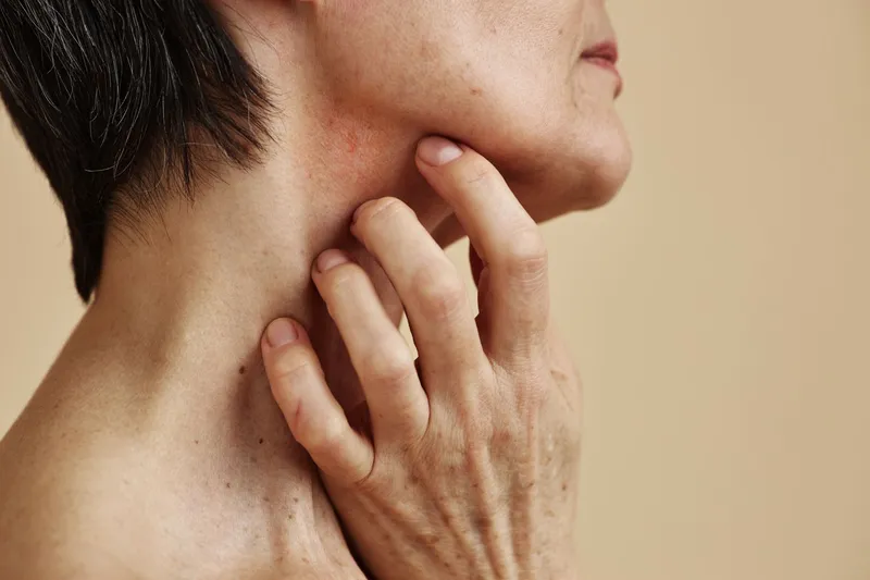 Lỗ chân lông bị bít tắc có thể dẫn đến tình trạng nổi mụn ở cổ
