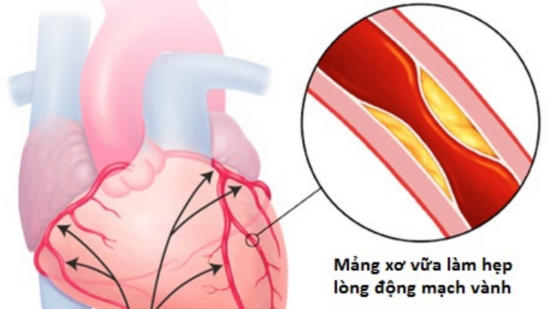 Minh hoạ tắc nghẽn động mạch vành