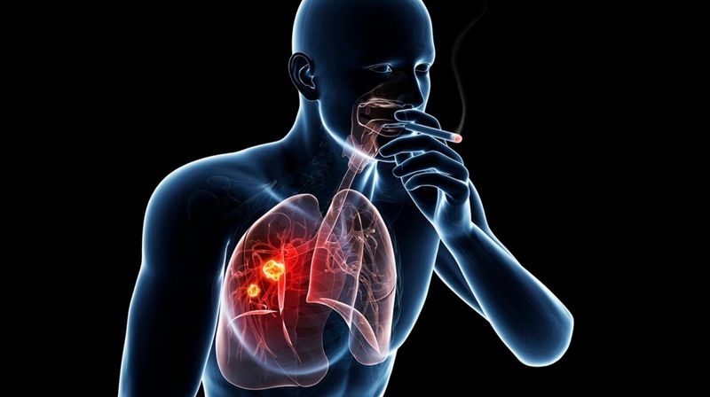 Ung thư phổi có di truyền không? Tỷ lệ là bao nhiêu? 