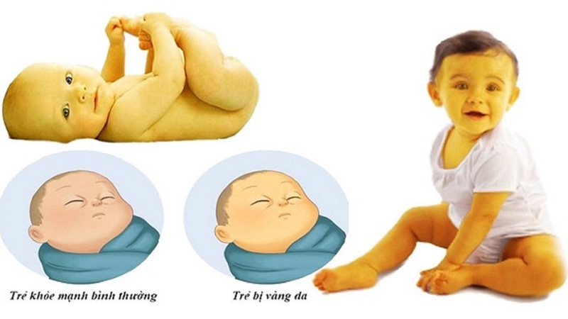 Hình ảnh minh họa quá trình hình thành bilirubin trong cơ thể. 