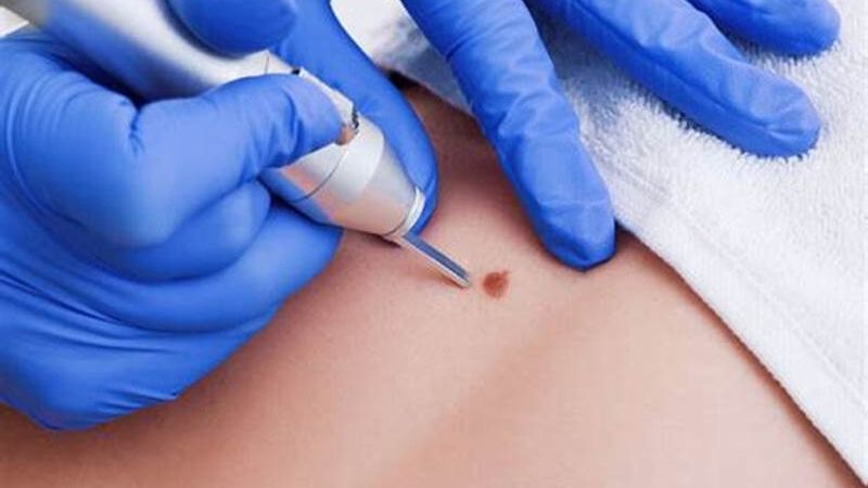 Kiểm tra nốt ruồi định kỳ giúp phát hiện sớm các bất thường về da 