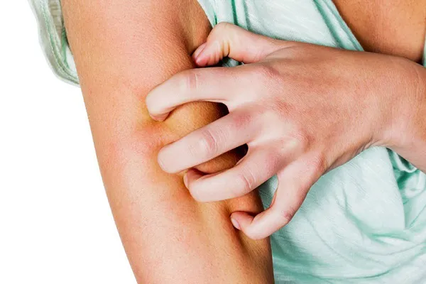 Cần lưu ý các triệu chứng toàn thân đi kèm với ngứa bàn chân 