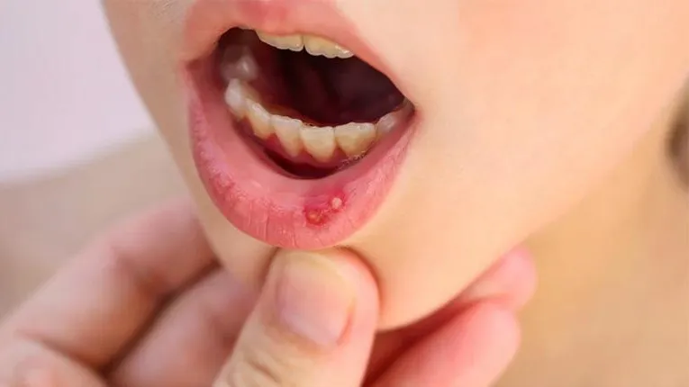 Một số yếu tố sức khỏe có thể làm tăng nguy cơ nổi đẹn trong miệng