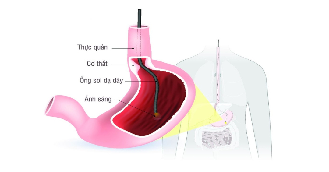 Nội soi dạ dày phát hiện polyp