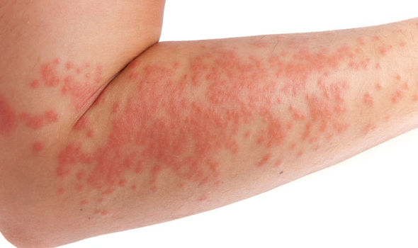 Eczema có triệu chứng da đỏ, ngứa, viêm