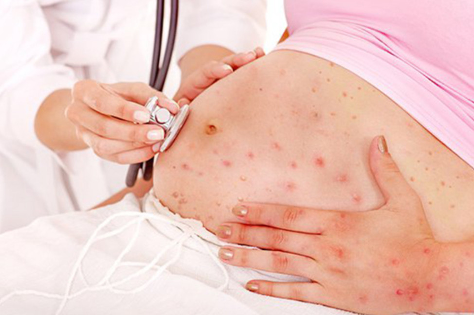 Mẹ bầu bị nhiễm virus Rubella có thể gây ra đa ối