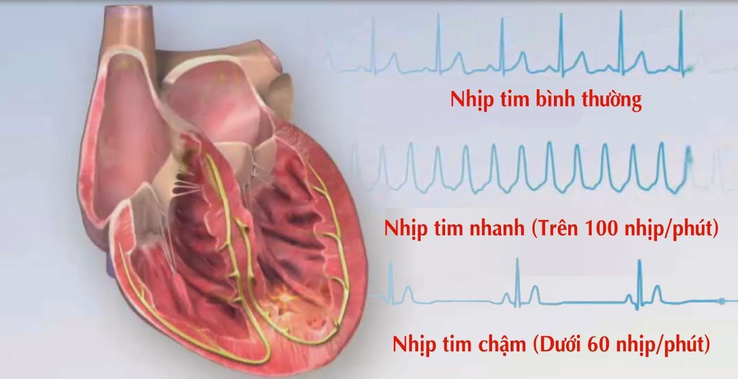 Nhịp tim quá nhanh hoặc quá chậm là biểu hiện lâm sàng của bệnh rối loạn nhịp tim