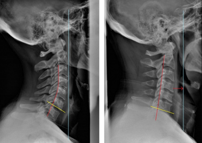 Chụp X - quang cột sống cổ thẳng và nghiêng để phát hiện các vấn đề về khớp, xương