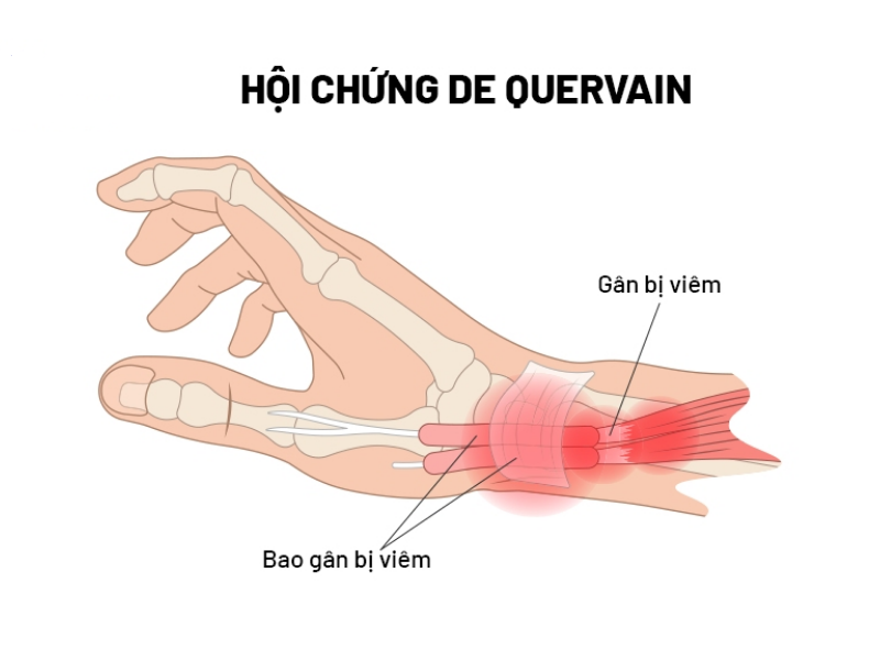 Hội chứng De Quervain là nguyên nhân gây đau cổ tay sau sinh phổ biến.