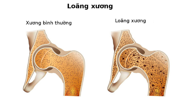 Loãng xương - nguyên nhân chủ yếu dẫn đến đau cơ xương khớp ở người cao tuổi