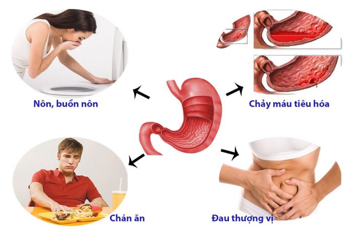 Dấu hiệu của viêm loét dạ dày 