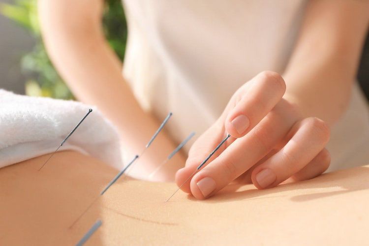 Châm cứu có thể làm giảm đau dây thần kinh