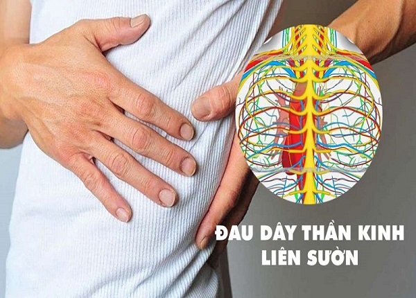 Đau dây thần kinh liên sườn là tình trạng đau nhói hoặc đau âm ỉ dọc theo các dây thần kinh liên sườn