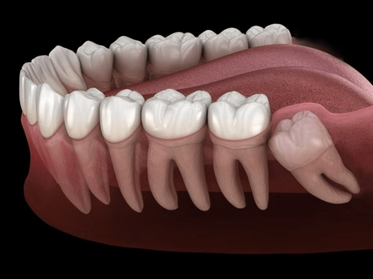 Răng khôn mọc lệch có thể gây nguy hiểm nếu không xử lý kịp thời? Khám phá thông tin chi tiết về răng khôn và cách xử lý cùng Pharmacity.