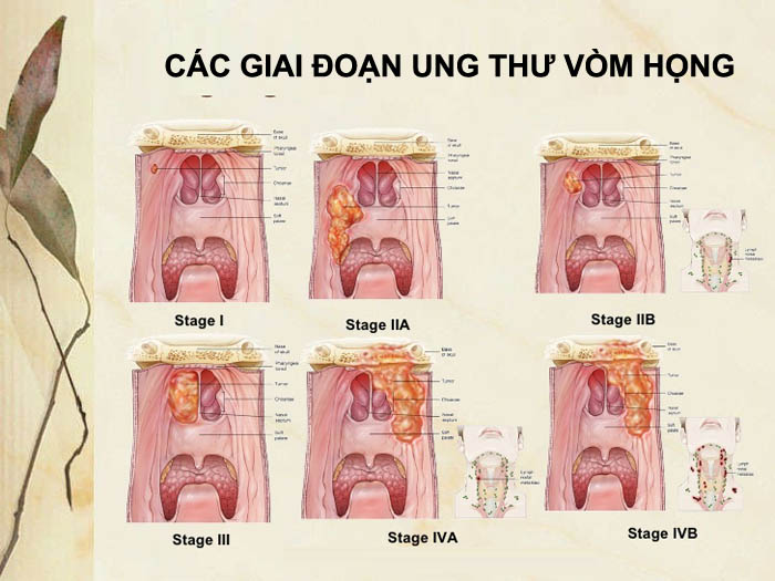 Chẩn đoán hình ảnh giúp bác sĩ xác định chính xác mức độ xâm lấn của khối u 