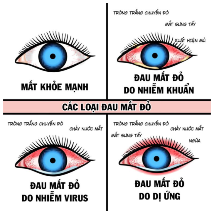 Bệnh đau mắt đỏ: Nguyên nhân và triệu chứng cần chú ý