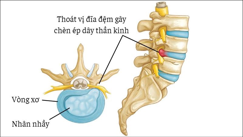 Thoát vị đĩa đệm là nguyên nhân chủ yếu gây bệnh đau thần kinh tọa