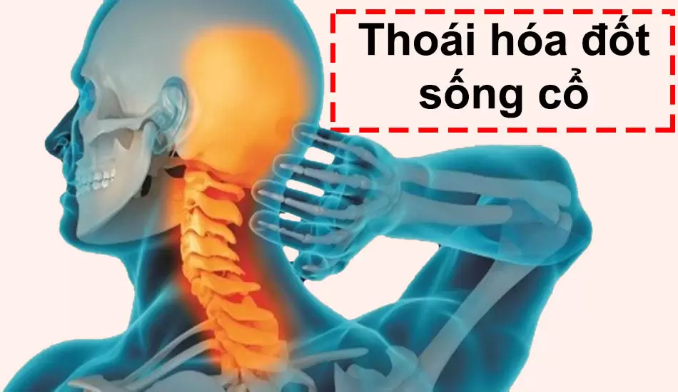 Thoái hóa cột sống có thể gây ra đau cổ vai gáy