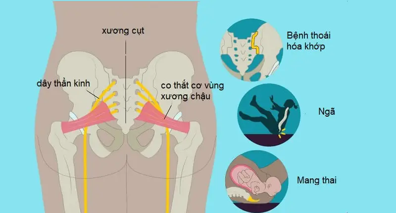 Nguyên nhân đau xương cụt