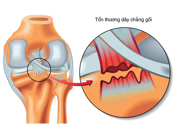 Có nhiều nguyên nhân gây ra đứt dây chằng.