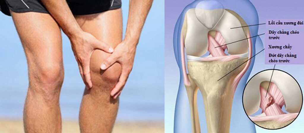 Hình ảnh minh họa các cấp độ tổn thương của dây chằng khi bị kéo căng quá mức