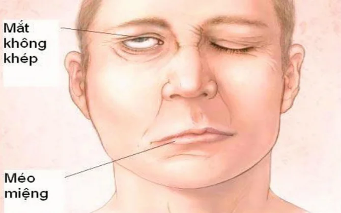 Hình ảnh liệt dây thần kinh số 4