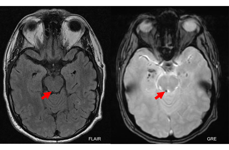 Có thể chẩn đoán bằng phương pháp CT scan