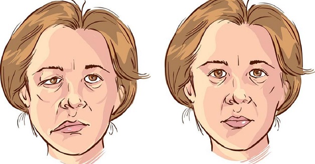 Liệt mặt: Cách phát hiện sớm và xử lý kịp thời