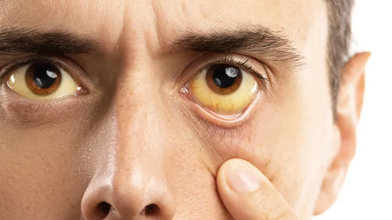 Mệt mỏi kéo dài kèm vàng củng mạc mắt là dấu hiệu men gan cao điển hình