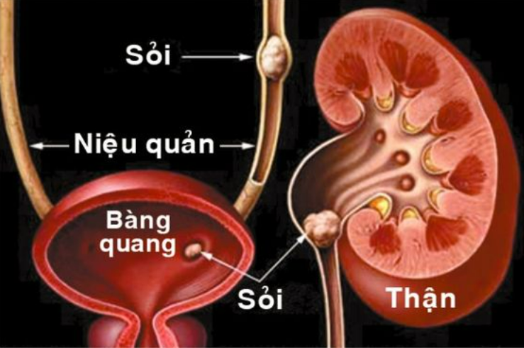 Hình ảnh sỏi tiết niệu