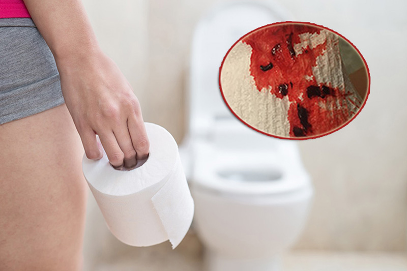 Đi ngoài ra máu là biểu hiện của những bệnh gì? Cần làm gì?