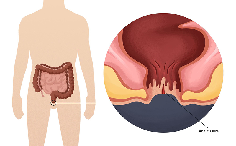 Táo bón gây nứt hậu môn và dẫn đến đi ngoài ra máu