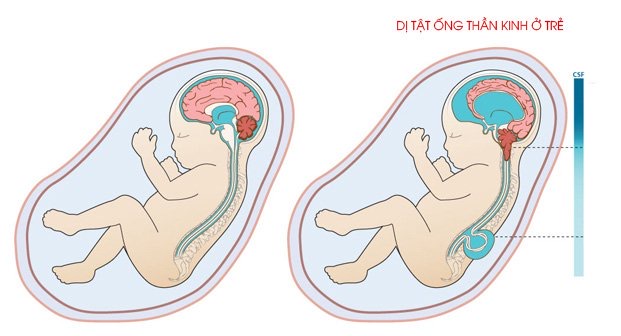 Dị Tật Ống Thần Kinh: Nguyên Nhân, Cách Phòng Ngừa và Phát Hiện Sớm