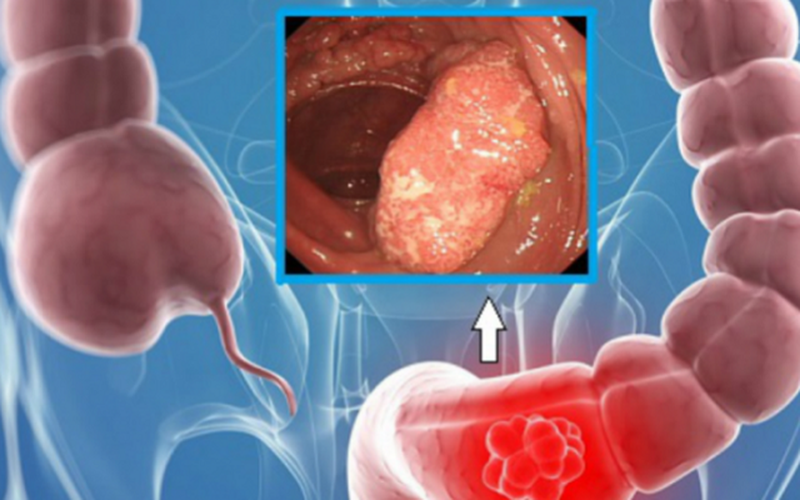 Hội chứng polyp đại trực tràng gia đình làm tăng nguy cơ mắc ung thư trực tràng