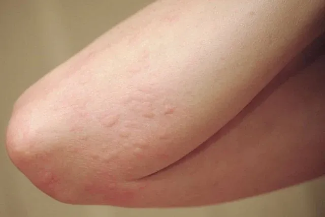 Kiểm soát viêm da dị ứng nhờ điều trị đúng cách.