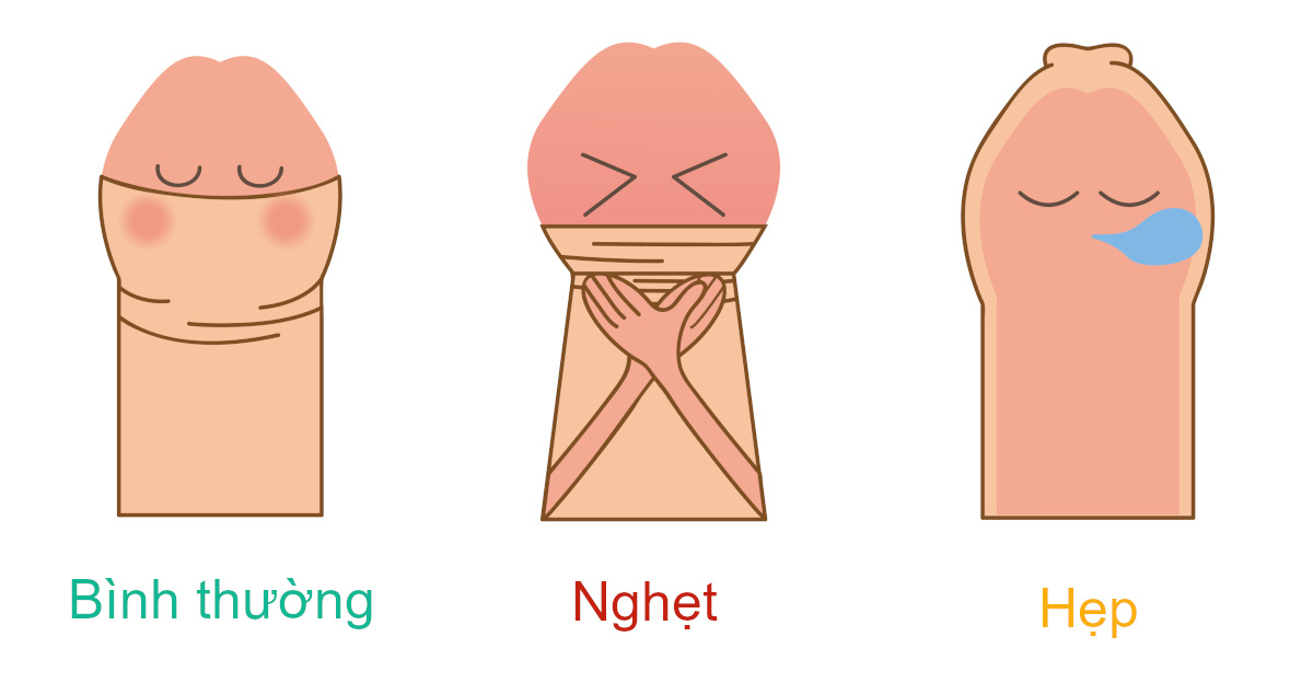 Phương pháp điều trị hẹp bao quy đầu hiệu quả