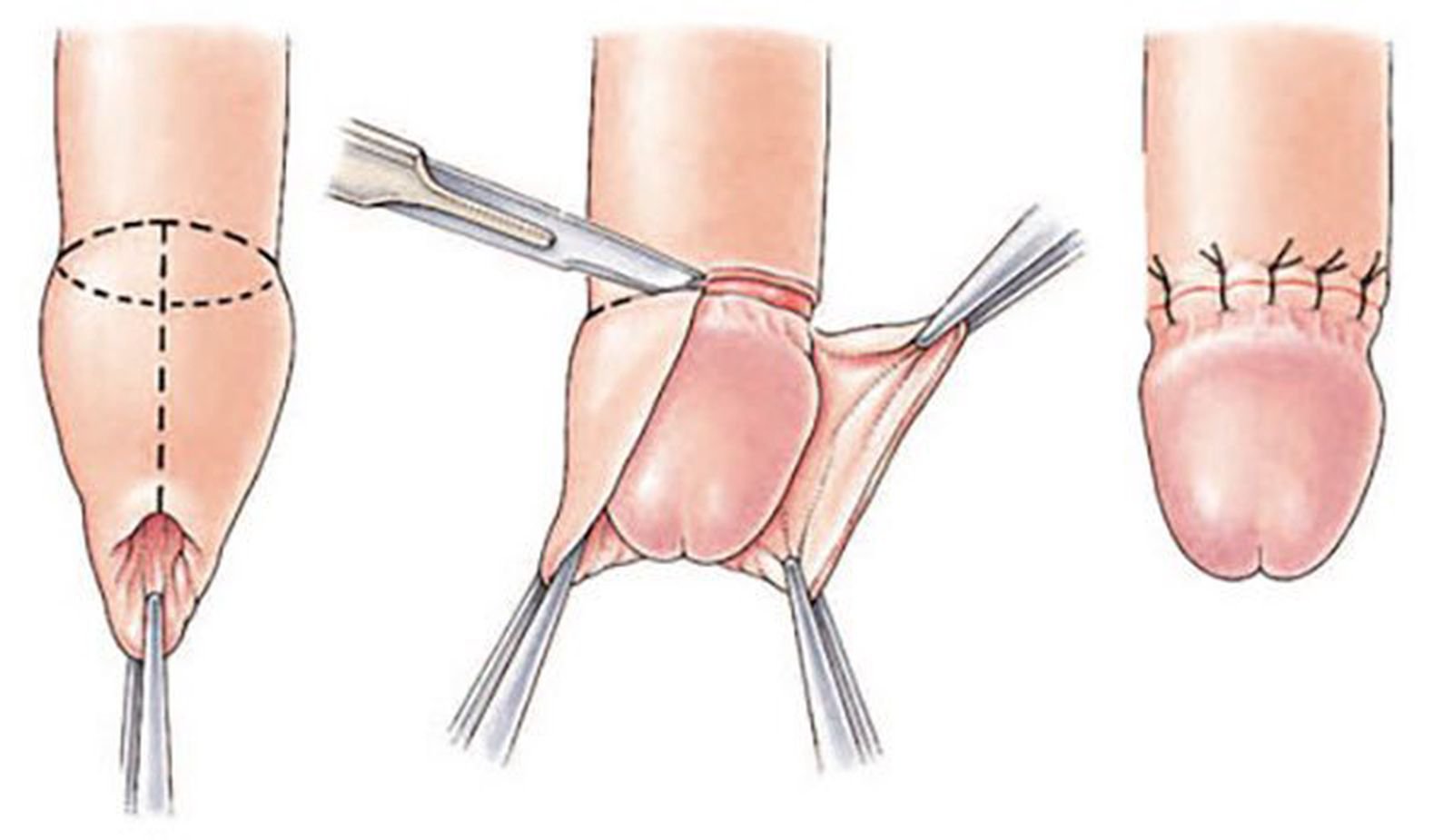 Phương pháp điều trị hẹp bao quy đầu