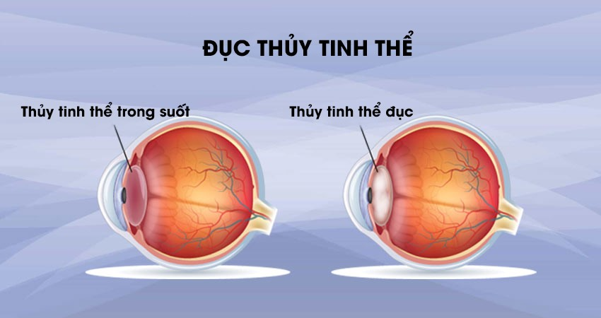 Hình ảnh bị đục thủy tinh thể