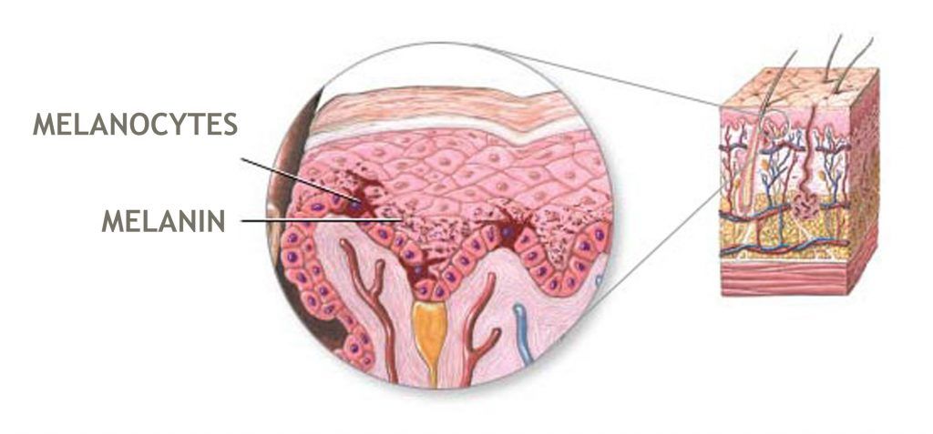 Nám da, tàn nhang và đồi mồi xuất hiện do sự sản sinh không đồng đều của melanin trên da