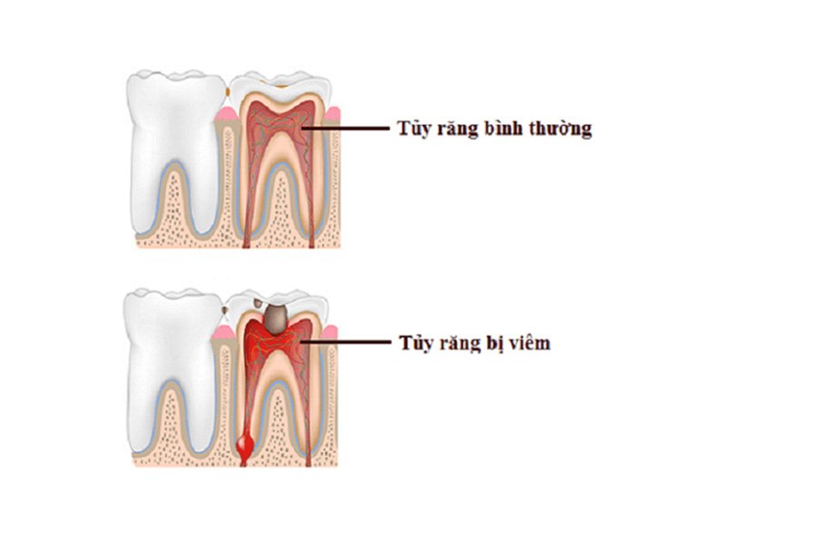 Viêm tủy răng