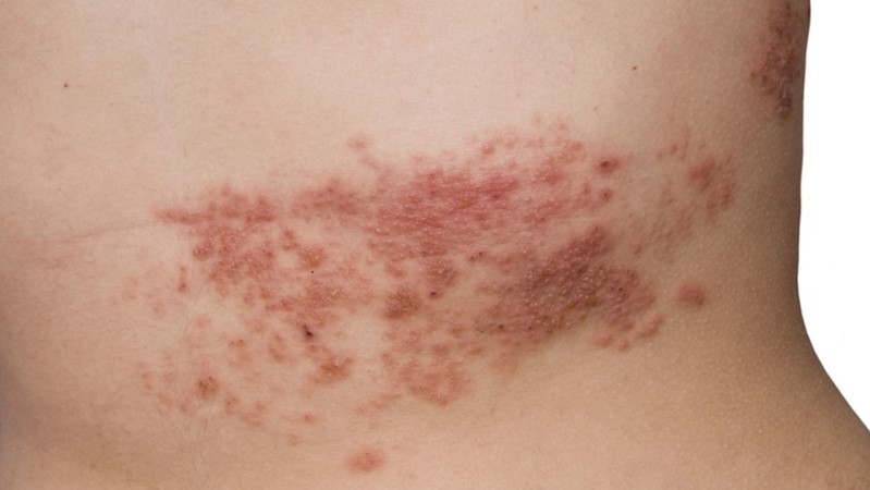 Zona thần kinh là một bệnh nhiễm trùng tái phát do virus Varicella-zoster gây ra