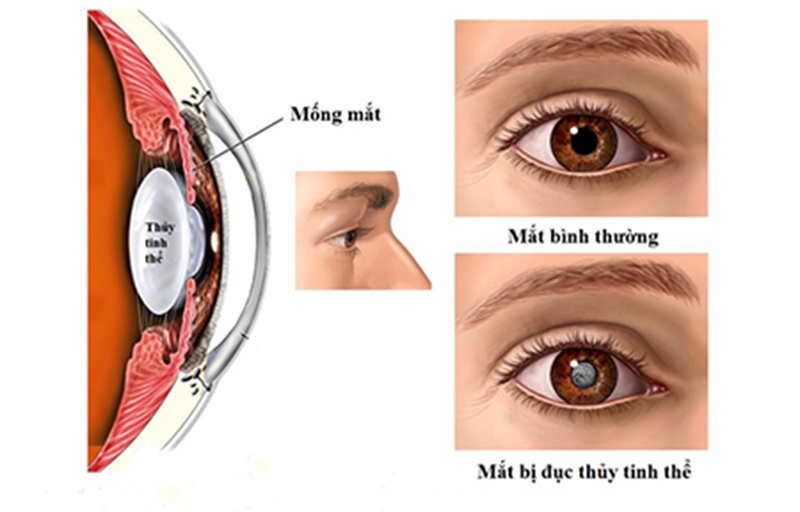 Mắt bị đục thủy tinh thể và mắt bình thường