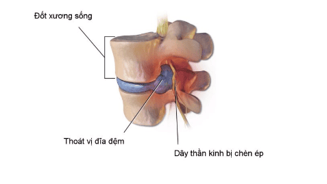 Thoát vị đĩa đệm gây chèn ép thần kinh