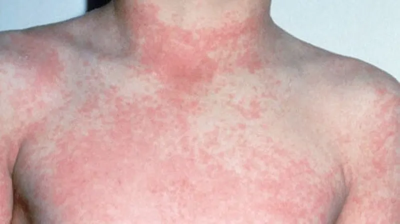 Ngứa toàn thân vào ban đêm có thể ảnh hưởng đến giấc ngủ và sinh hoạt hàng ngày