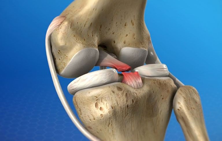 Đứt dây chằng gây đau đớn và ảnh hưởng đến hoạt động