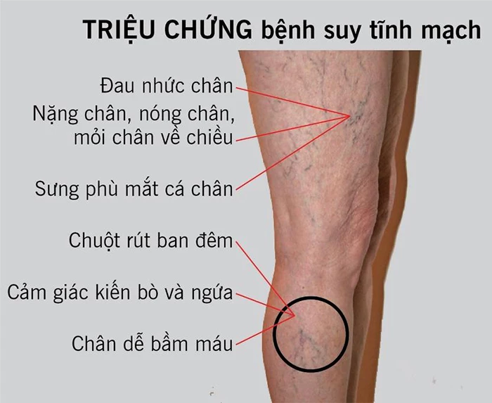 Triệu chứng điển hình của giãn tĩnh mạch 