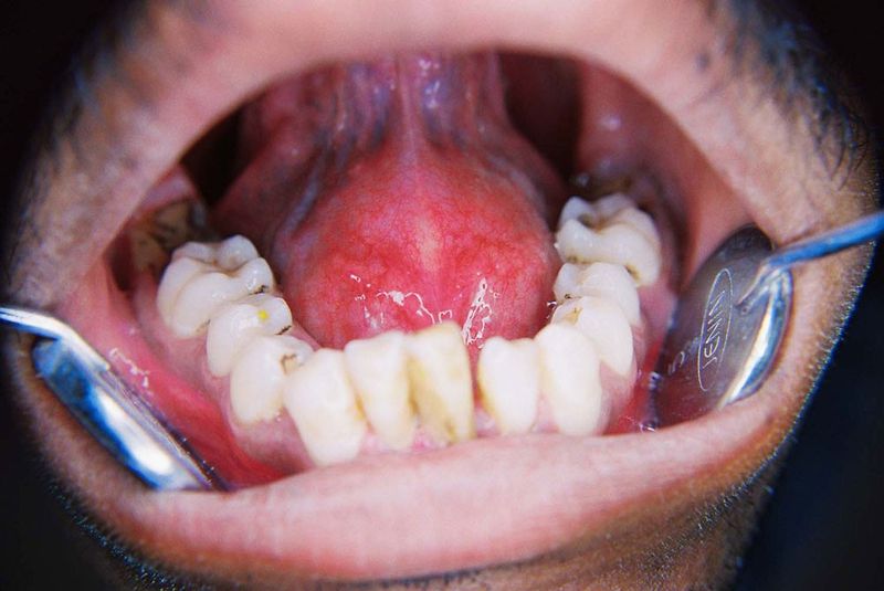 Thực phẩm cay nóng có thể làm tăng cảm giác đau rát khi niêm mạc lưỡi đang bị loét