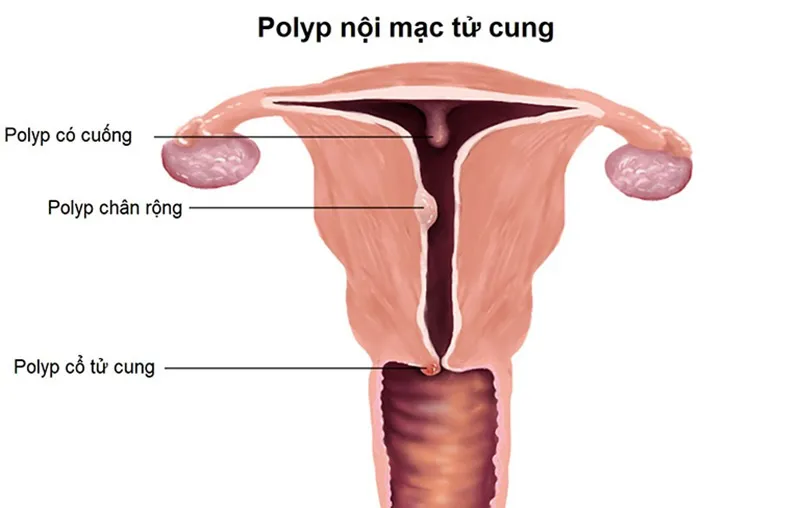 Niêm mạc quá dày có thể là rào cản ngăn cản phôi thai làm tổ trong buồng tử cung