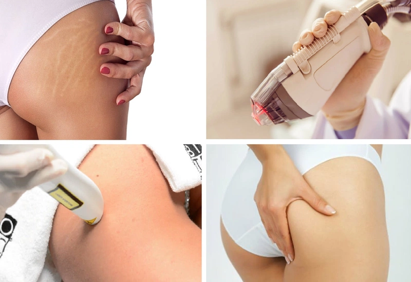 Trị rạn da sau sinh bằng laser: phương pháp hiệu quả và an toàn
