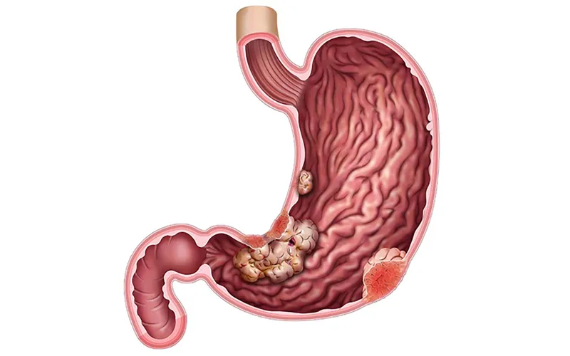 Gist dạ dày (khối u mô đệm đường tiêu hóa) - hiểm họa từ hệ tiêu hóa|